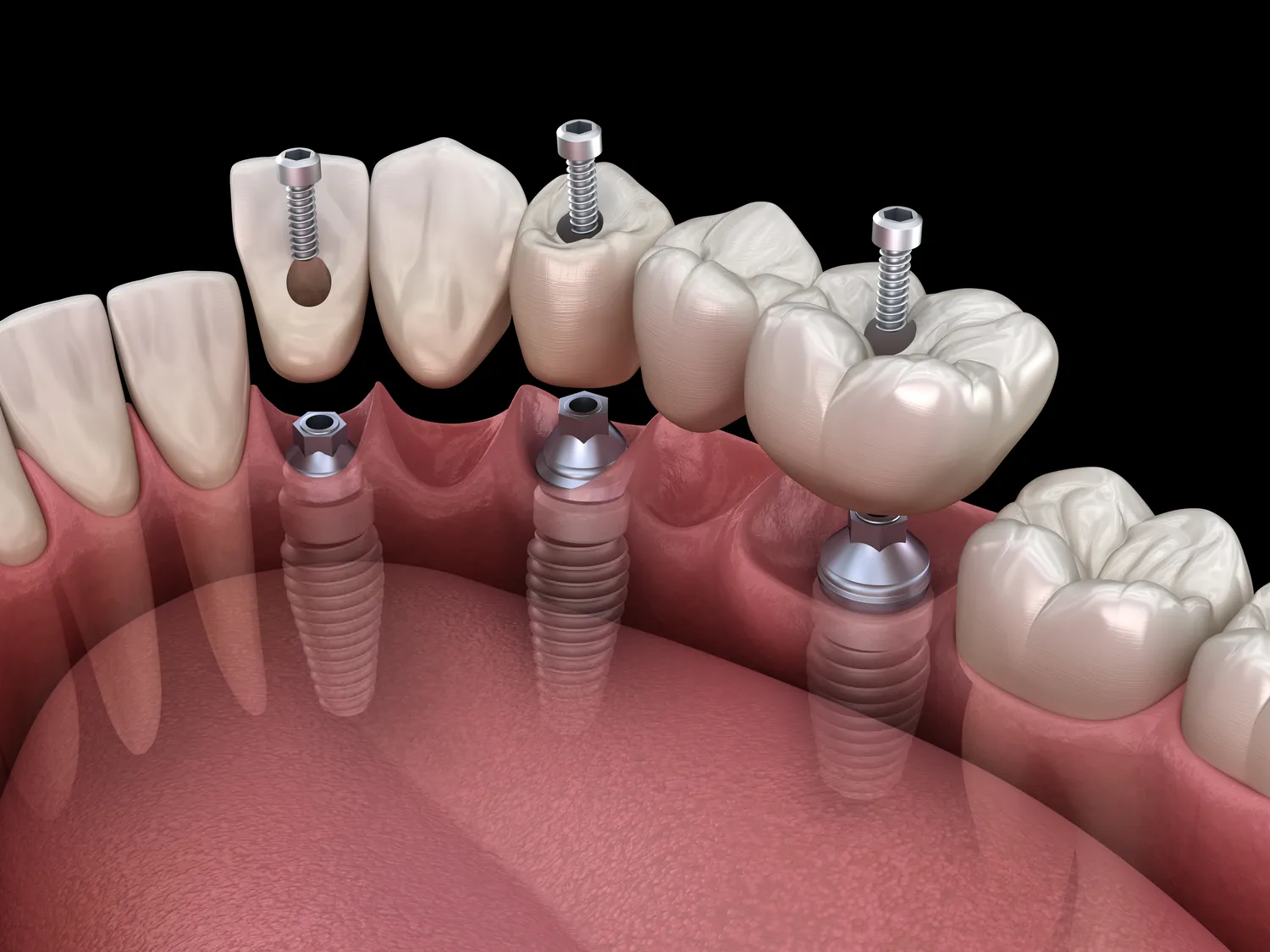 Zabiegi dentystyczne refundowane przez NFZ