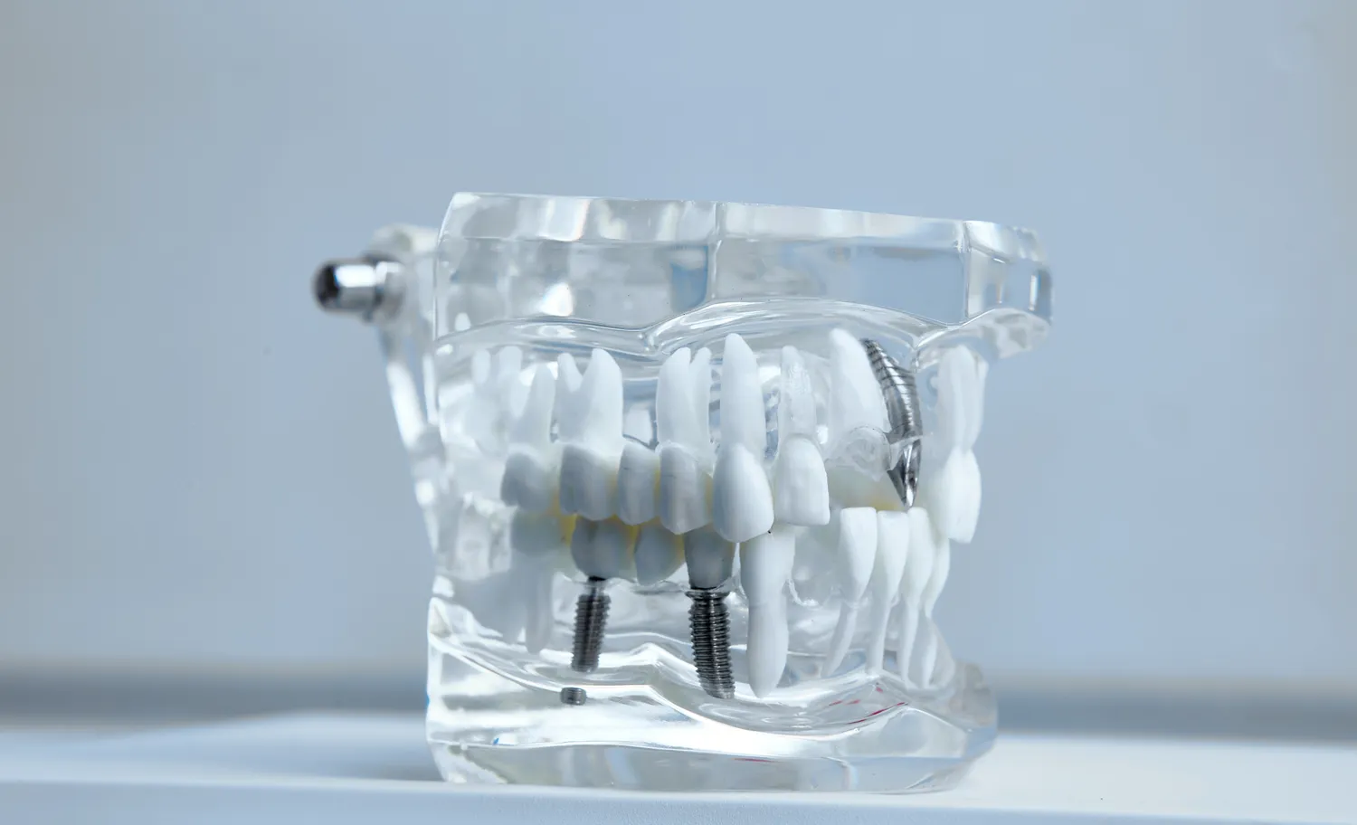Implanty zębowe - proces zakładania implantu zębowego