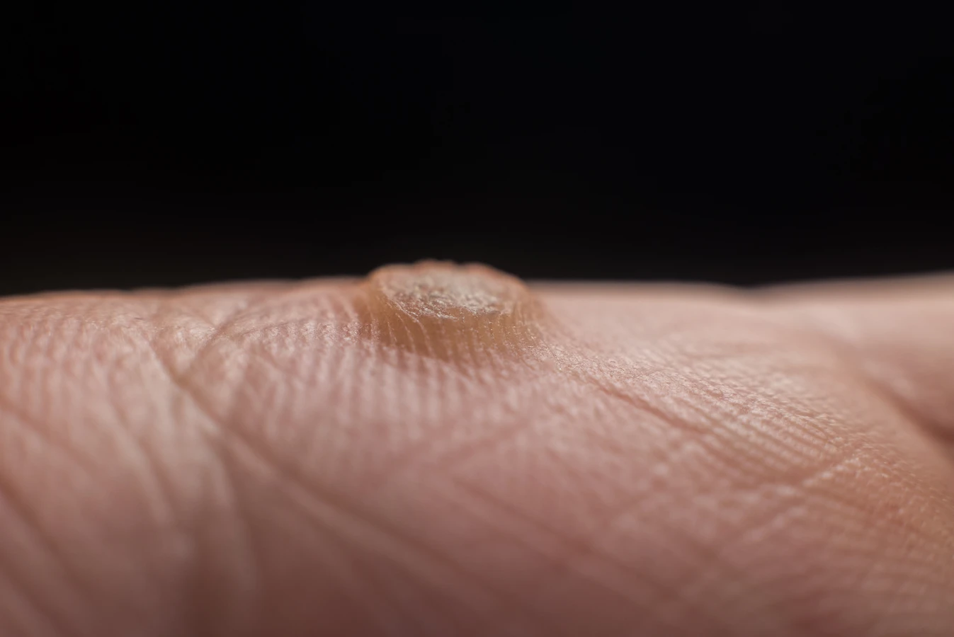 Co na kurzajki u dziecka?