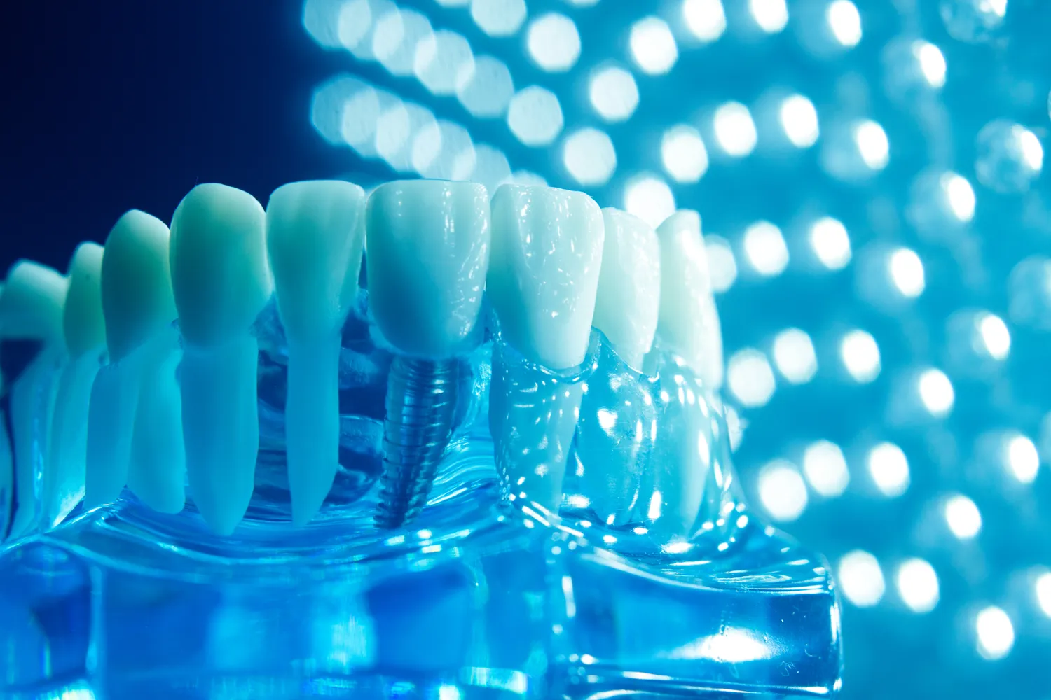 Zęby w jeden dzień Świnoujście