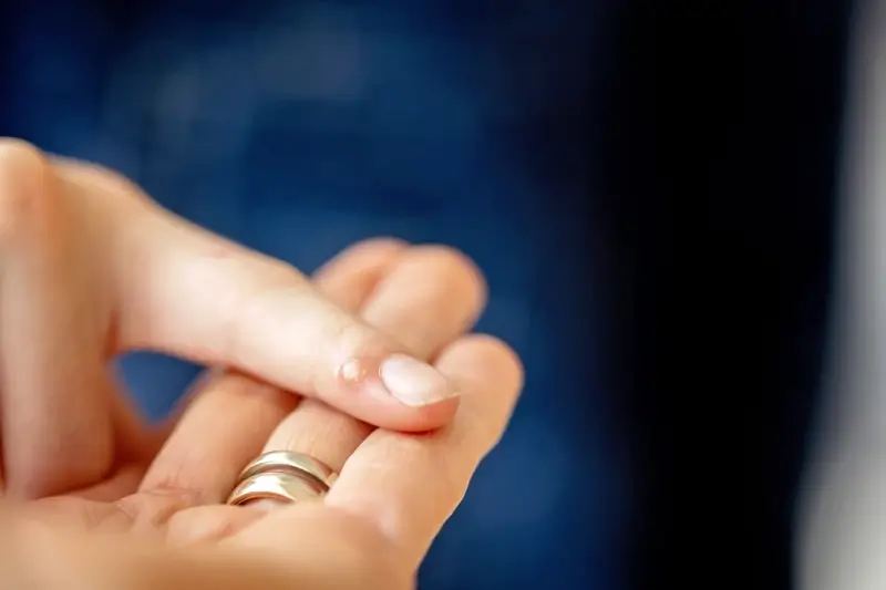 Jaskółcze ziele na kurzajki jak stosować?